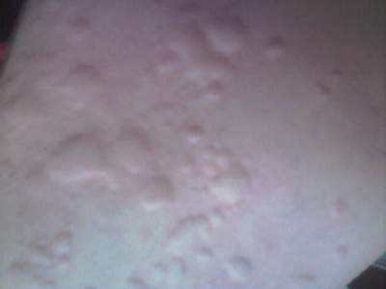 src=http___online.xywy.com_pfk_uploads_uploads_allimg_151028_-1-15102Q540445Y.jpg&refer=http___online.xywy_1