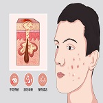 中山治青春痘费用多少钱