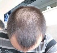 中山哪个医院治脱发好