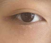 中山汗管瘤的症状表现