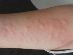 中山如何预防儿童过敏