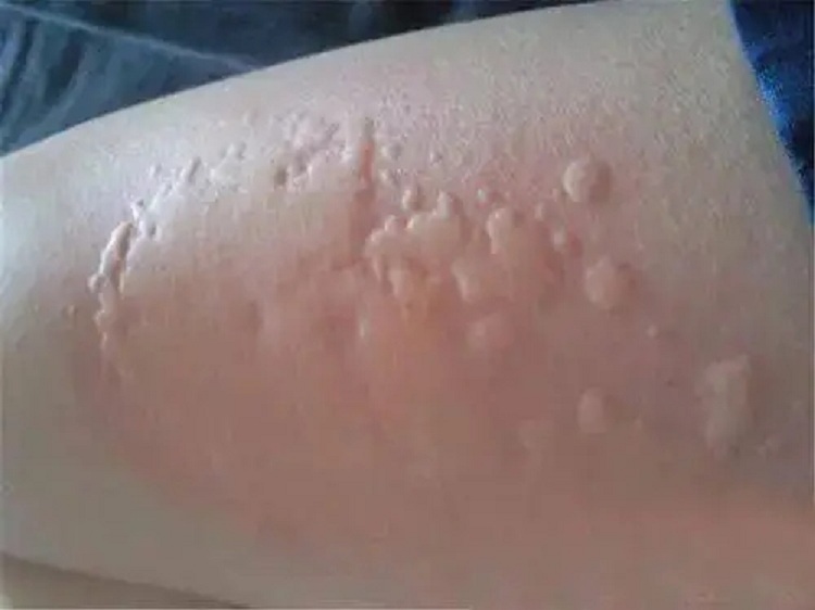 中山肤斗士皮肤病专科