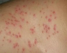 中山治毛囊炎好的医院
