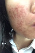 中山治疗痘坑需要哪些禁忌