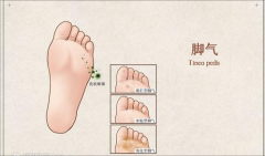 在中山脚气患者日常需要注意什么