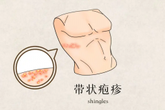 带状疱疹的症状是怎么样的