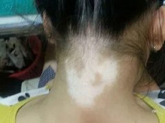 中山儿童白癜风治疗费用