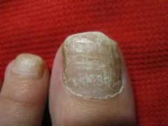 灰指甲给我们哪些危害