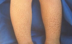 鱼鳞病的病发症状