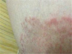 股癣有哪些预防方法