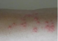 中山皮肤过敏如何护理