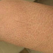 鱼鳞病发作有哪些因素