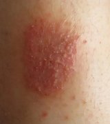 日常如何预防湿疹比较好