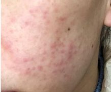 治痘痘需要多少钱