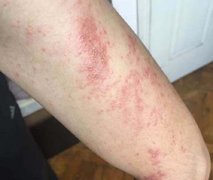 预防湿疹的有效措施