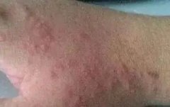 日光性皮炎的症状表现