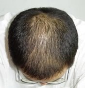 脂溢性脱发有哪些症状