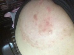 治疗皮炎需要注意什么