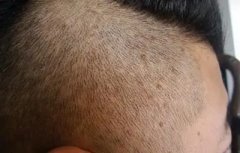 夏季应该怎么护理毛囊炎