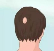 斑秃临床症状有什么