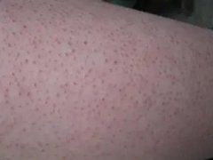 毛囊炎的预防有哪些方法