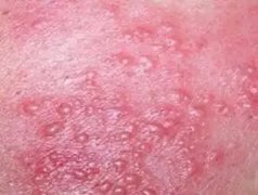 预防过敏性皮炎有哪些措施
