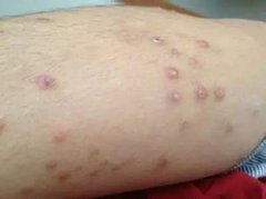 预防湿疹注意事项