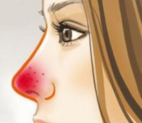 中山酒糟鼻危害有什么