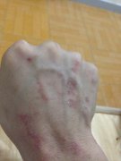 中山手足癣发病原因有什么