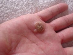 中山寻常疣预防有哪些方法
