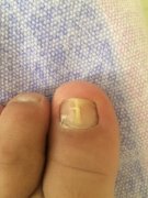 灰指甲症状有哪些