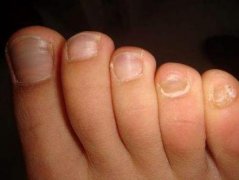 灰指甲需要注意事项