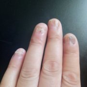灰指甲对患者的危害