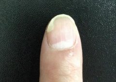 灰指甲注意饮食事项