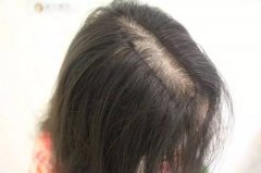 女性脱发症状怎么样的
