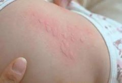荨麻疹发病的原因