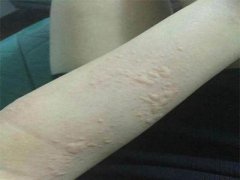 荨麻疹日常护理方法