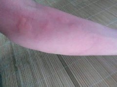 荨麻疹有什么因素引起的