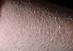 鱼鳞病预防的方法