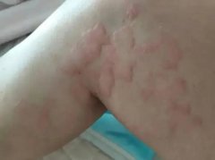 荨麻疹的类型怎么样