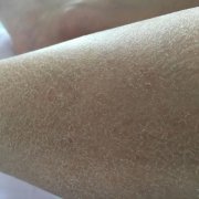 鱼鳞病是怎么引起的