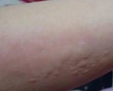 荨麻疹复发怎么处理好