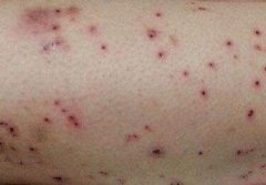 毛囊炎对患者产生的影响