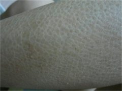 鱼鳞病的预防措施怎样