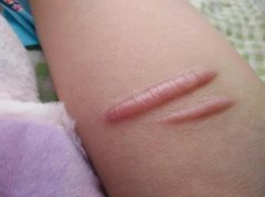 生活如何改善疤痕