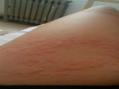 荨麻疹反复发作原因怎么样的