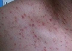 头部毛囊炎症状怎么样的