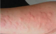 如何有效预防荨麻疹