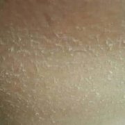 鱼鳞病会产生的危害