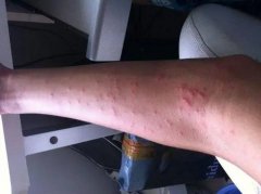 荨麻疹症状表现有什么